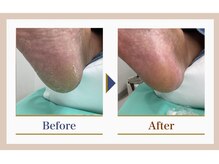 巻き爪補正店 錦糸町店/【踵ケア】