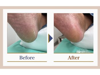 巻き爪補正店 錦糸町店/【踵ケア】