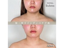 術後の女神 大阪本町店/ダウンタイムケア・インディバ