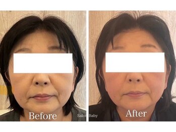 サロンベイビー 西宮本店(Salon Baby)/【BeforeAfter】小顔美容整顔