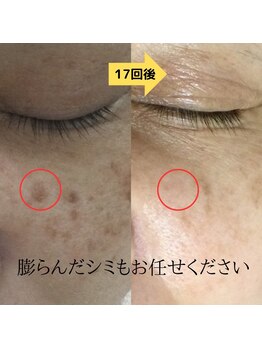 パルサロン(palsalon.)/シミケア