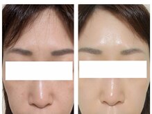 アン(anne)/ハーバルピールで陶器肌☆亀戸♪