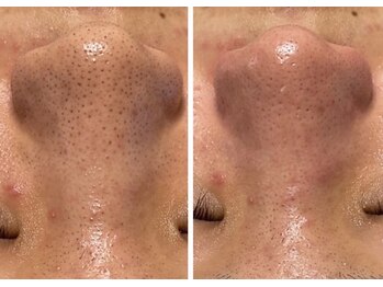 ヨハク(YOHAKU)/毛穴洗浄