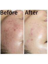 バイオビューティー 神戸本店(Bio Beauty)/ハーブピーリング症例