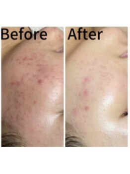 バイオビューティー 神戸本店(Bio Beauty)/ハーブピーリング症例