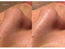 シューラディアント(ShuRadiant)/毛穴ケア/毛穴洗浄/ハイドロ