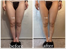 ビノスビューティー(vinos.beauty)/症例写真　下半身痩身1回
