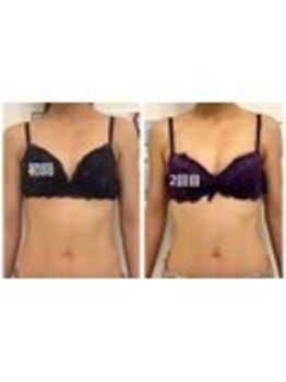 美人バスト 表参道店/ バストアップ症例/産後/2回目