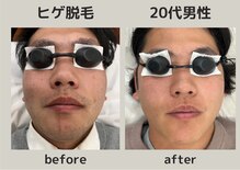 エピリス(EPILIS)