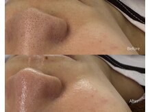 アピール(Appeal)の雰囲気（人気！鼻Waxで黒ずみ毛穴を改善！）