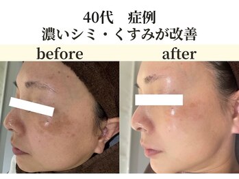 パールホワイトニング/40代 シミ改善症例