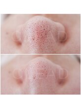 クリード(CLEAD)/毛穴洗浄☆ハイドラフェイシャル