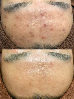 脱毛専門店 美的/美肌改善プラチナクレイピール!