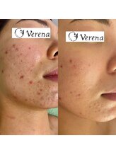 タマ(tama)/verenaハーブピーリング　