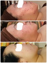 セラヴィ(CELAVIE)/肌質改善