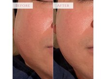 アンドニューリー(&NEWLY)/水玉リフティング　Before After