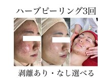 3000店舗で全国1位の実績！本当にお悩みの方へ本気のニキビケア