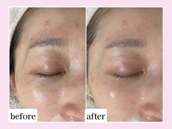 カレン アイビューティー(Karen Eyebeauty)/ララピール1回目