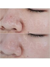 クリード(CLEAD)/毛穴洗浄☆ハイドラフェイシャル