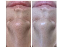 ココ(coco)/毛穴の汚れごっそり落とします♪