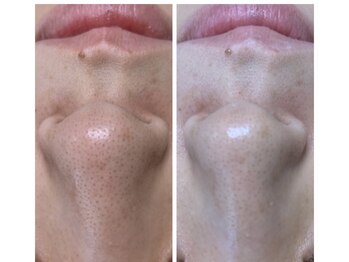 ココ(coco)/毛穴の汚れごっそり落とします♪