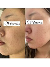 タマ(tama)/verenaハーブピーリング　