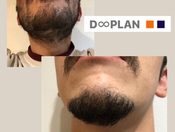 ディープラン 南箕輪店(D∞PLAN)/【メンズヒゲ脱毛】