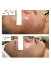 ビズビズ 梅田店(bisebise)/梅田ハーブピーリング/ニキビ