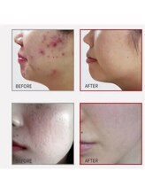 フィス エステティックサロン/毛穴/ニキビ/肌荒れケア