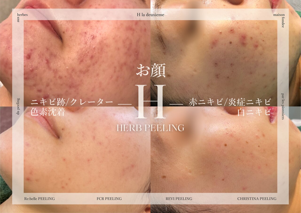 ハーブピーリング アッシュ 梅田(H)｜ホットペッパービューティー