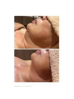 サリーエミリー 船橋店(SallyEmiry)/脂肪にアプローチ★計5回の効果