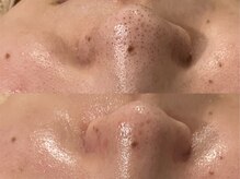 エメ 心斎橋(Aimer)の雰囲気（お手入れの定番！『毛穴洗浄』一度でも満足できる結果です☆）