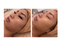 マ シェリエ(MA CHERIE)の雰囲気（繰り返す 頑固なニキビ、たるみ肌を本気でお肌を変えたい方へ）