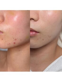 ルーンフェイシャルサロン 吉祥寺(Lune facial salon)の写真/【導入希少】美容大国韓国TOPエステ"トロイアルケ"で1人1人の肌&悩みに合わせた完全オーダーメイド肌管理を