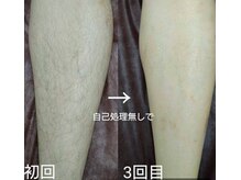 サロン ド リアン(Salon de Lien)/【脱毛ビフォーアフター】