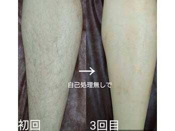 サロン ド リアン(Salon de Lien)/【脱毛ビフォーアフター】