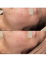 ハル(haru)/ビフォーアフター