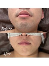 ボス 大曽根店(BOSS)/青ヒゲ悩みの解消！＃ヒゲ脱毛