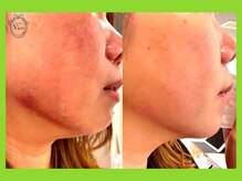 ヴィオール 名古屋栄店(VIOR)/ハーブピーリング　2グラム