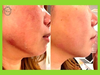 ヴィオール 名古屋栄店(VIOR)/ハーブピーリング 2グラム