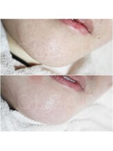 クリード(CLEAD)/毛穴洗浄☆ハイドラフェイシャル