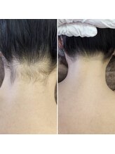 アナシアビューティーサロン(Anacia)/うなじ脱毛