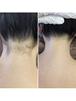 アナシアビューティーサロン(Anacia)/うなじ脱毛