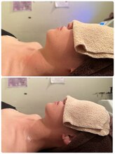 クイーンズ ピュア 新宿本店(Queen's Pure)/小顔・むくみケア