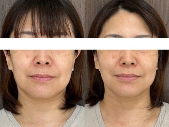 サクラ 本厚木駅前店(SAKURA)/【本厚木/シミケア/たるみケア】