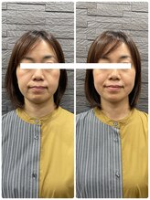 長寿鍼灸院 長寿整骨院/美容鍼50本の効果★小顔効果