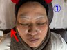 ◆美白美肌効果・光フェイシャル◆