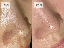 ヒナノ 矢場町店(HINANO)/RHRハーブピーリング