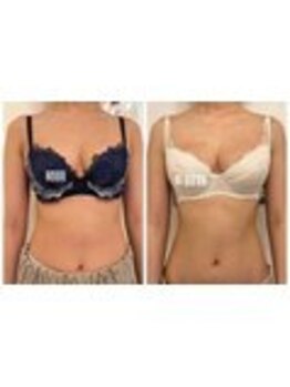 美人バスト 表参道店/バストアップ症例/育乳6回コース