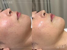 シェステ ゴジュウヨン(shesthe54)/【6回】before／after